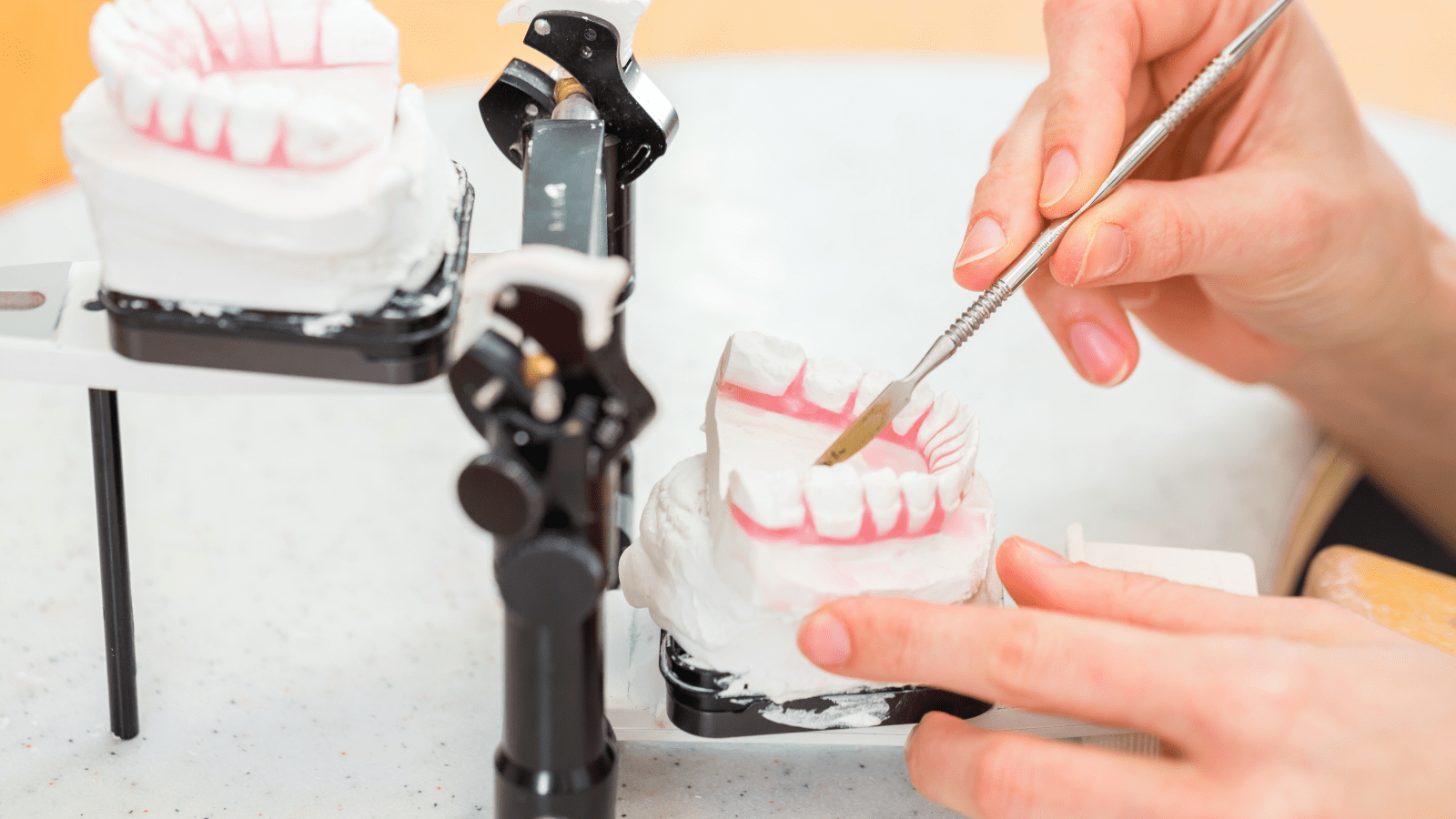 How long does permanent dental cement last?